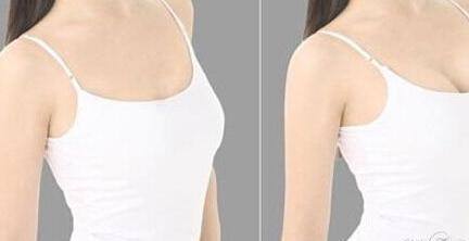 如何實(shí)現(xiàn)歐式芭比雙眼皮？手術(shù)之后有什么效果？