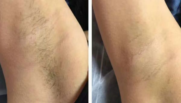 【2023年北京哪家醫(yī)院去痘坑好？專家推薦最適合你的選擇！】