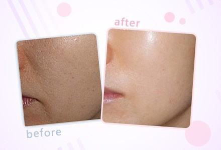 水動力吸脂和360環(huán)吸：哪種吸脂手術(shù)對身體傷害較??？