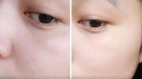 杭州去除痘坑哪家醫(yī)院好？選擇杭州專(zhuān)業(yè)去痘坑醫(yī)院的幾個(gè)關(guān)鍵點(diǎn)