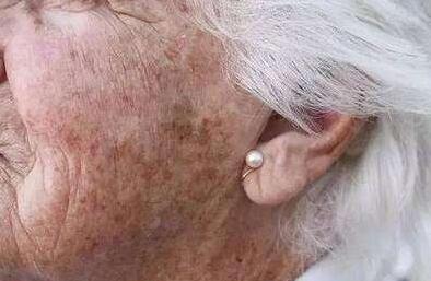 什么導(dǎo)致臉上出現(xiàn)黃褐斑？快來看看自己有沒有遭殃！