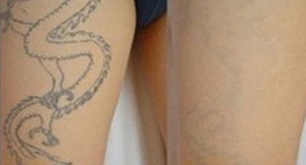 廣州哪家醫(yī)院做雙眼皮效果好，推薦一家專業(yè)整形醫(yī)院