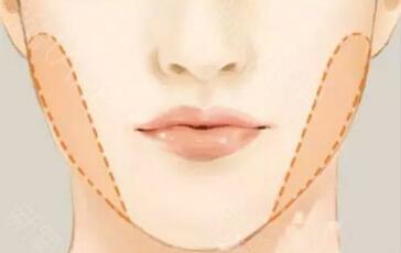 如何選擇適合自己的雙眼皮手術(shù)方式？詳解！