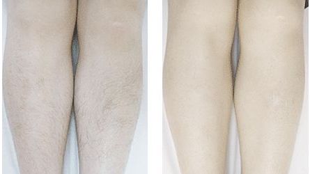 大連哪家醫(yī)院做酒窩好？選擇優(yōu)質(zhì)醫(yī)院打造完美酒窩的專業(yè)技巧詳解