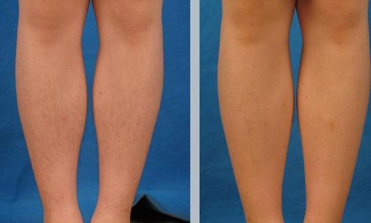 保定光子嫩膚哪家好？教你如何選擇適合你的醫(yī)院