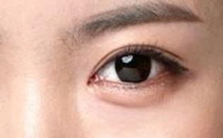 怎樣有效治療眼袋？適合你的是哪種方法？