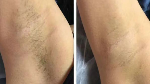 廊坊哪家雙眼皮整形醫(yī)院口碑好，專(zhuān)業(yè)雙眼皮割眼部效果好？