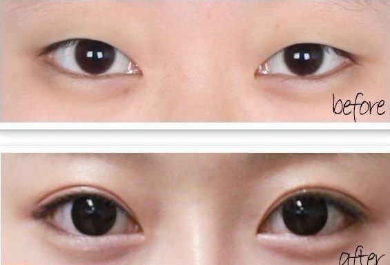 上海哪家醫(yī)院的黑眼圈治療效果好且受歡迎？