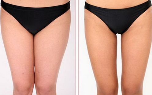 南寧哪家醫(yī)院手臂吸脂效果最佳？