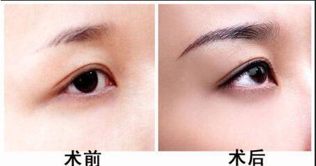 臥蠶、淚溝與眼袋有何不同？正確了解能有效解決嗎？