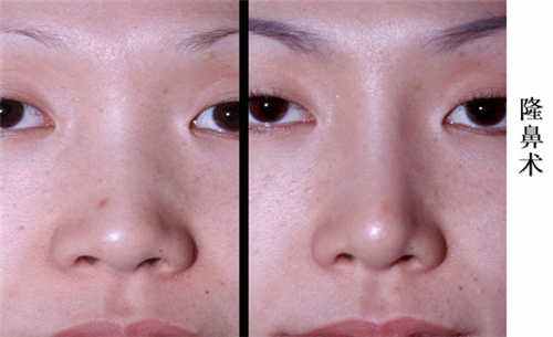 江蘇省中醫(yī)院整形美容科激光祛斑價格貴嗎？有什么推薦的祛斑方式？