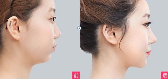 昆明達(dá)拉斯隆鼻效果如何？哪家醫(yī)美機(jī)構(gòu)靠譜？