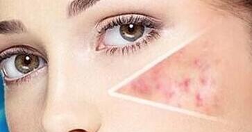 如何正確使用黑色面膜？黑色面膜的副作用有哪些？