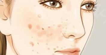 消滅粉刺的補(bǔ)水美白原理為何？