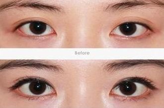 合肥隆鼻修復(fù)哪家醫(yī)院好？專業(yè)醫(yī)院排行榜及術(shù)后效果對比！