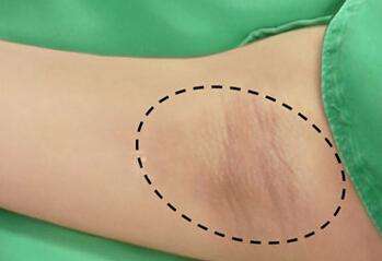 芭比款是適合哪種眼型的？知道雙眼皮手術(shù)的價(jià)格嗎？