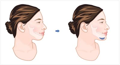 什么樣的人適合光子嫩膚去黑眼圈術？注意事項是什么？