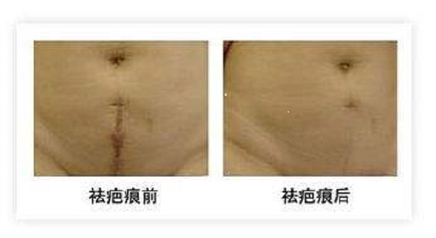 扇形雙眼皮適用于所有人群嗎？