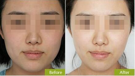 耳垂整形手術(shù)會有明顯疤痕嗎？如何有效避免疤痕出現(xiàn)？