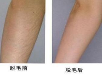 廣州兔唇修補(bǔ)術(shù)哪家醫(yī)院好？專家推薦的廣州兔唇修補(bǔ)術(shù)醫(yī)院大揭秘