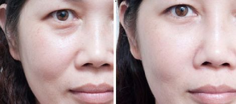 煙臺(tái)雙下巴溶脂針整形醫(yī)院口碑排名大揭秘