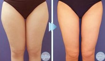 西安面部提升收緊效果哪家醫(yī)院好？