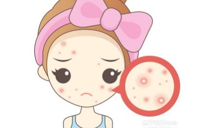 安安粉刺露用法正確嗎？真的有效果嗎