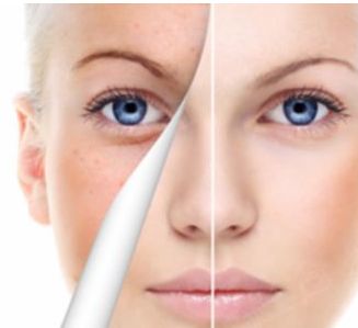 南寧哪家醫(yī)院專業(yè)治療胎記效果好？