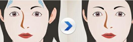 玻尿酸填充效果顯著？消腫需要多久？