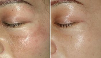 石家莊激光祛斑哪家靠譜？一文帶你選擇最好的祛斑機(jī)構(gòu)！