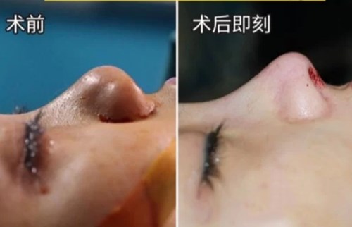 為什么外眼角手術(shù)后不留疤痕，如何進(jìn)行護(hù)理？