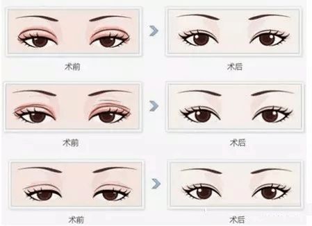 廣州臀部整形醫(yī)院推薦排名及評價解析