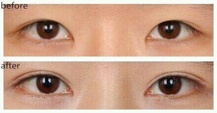 哪家寧波整形醫(yī)院在2023年排名前十，面部下垂提升效果好？