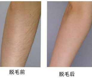 襄陽哪家醫(yī)院治療雀斑好？雀斑治療專家推薦！