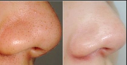 浙江隆胸手術(shù)哪家醫(yī)院好？浙江隆胸手術(shù)醫(yī)院排名及選擇技巧解析