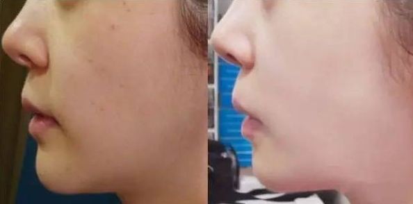 天津激光祛痘哪家醫(yī)院好？全面評(píng)估天津?qū)I(yè)激光祛痘醫(yī)院的優(yōu)勢(shì)