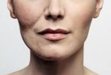 伊凡露注射除皺的特點(diǎn)及注意事項(xiàng)是什么？