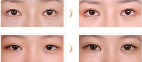 東營膠原蛋白祛魚尾紋的權威醫(yī)院推薦