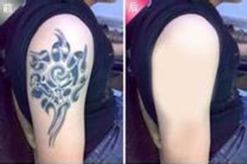 頰脂墊切除整形手術(shù)的價(jià)格是多少？適宜什么樣的人進(jìn)行頰脂墊切除手術(shù)？