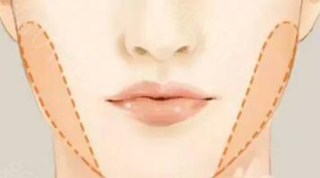 平扇與開扇，哪種更適合？重要術(shù)前須知！