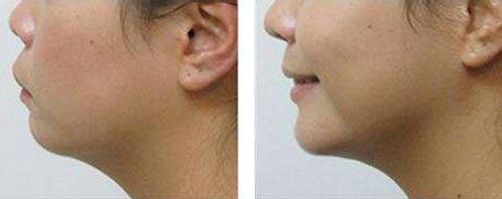 如何以嗨體熊貓改善眼部皺紋？專業(yè)護(hù)理技巧解析