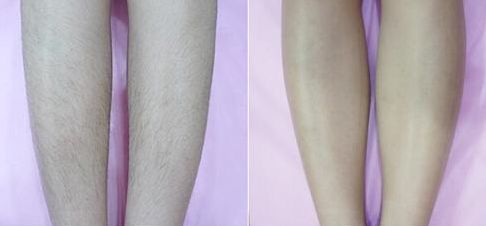 襄陽看扁平疣應該選擇哪家醫(yī)院好？