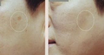 深圳哪家醫(yī)院的雙眼皮手術(shù)效果最佳？