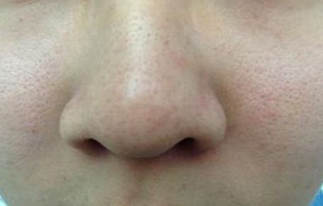 寧波哪家醫(yī)院的祛黃褐斑效果好且受到用戶好評(píng)？