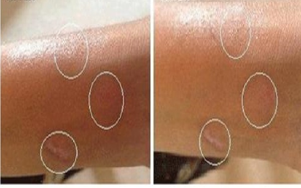 oe光子嫩膚療程費用合理嗎？治療效果如何評價？