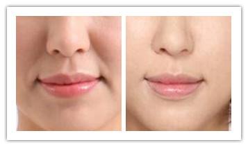 為什么輪廓針的使用要注意什么？效果如何？