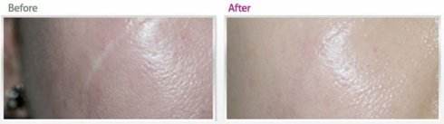 軟骨隆鼻手術(shù)安全有效嗎？