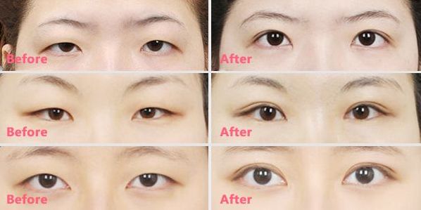 王曉晨的整容傳聞揭秘：真相到底如何？