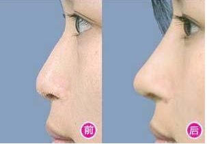 廣州整鼻最好醫(yī)院哪家好？2023年最新排名發(fā)布！