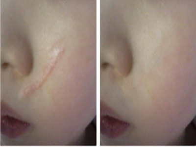 中山電波拉皮祛印第安紋醫(yī)療機構(gòu)哪家靠譜？2023年中山電波拉皮祛印第安紋美容醫(yī)院排行榜前十實用指南！